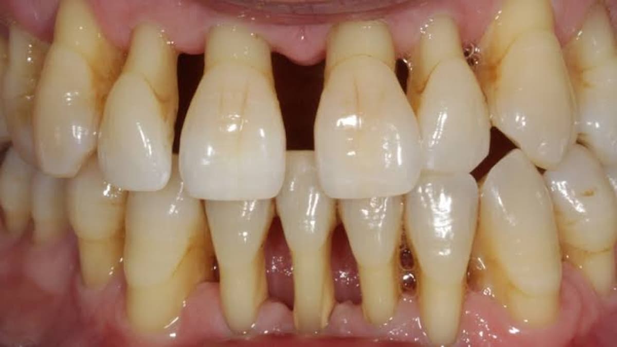 Perio mouth